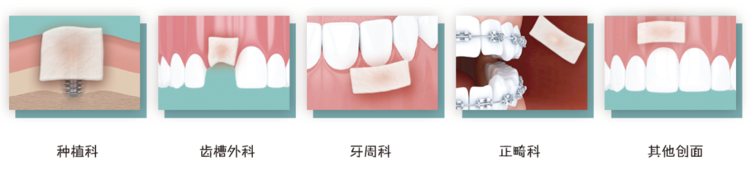 医用壳聚糖什么作用【新品上市】壳聚糖基生物医用材料--博益优立合贴（覆膜型）_https://www.jmylbn.com_新闻资讯_第5张