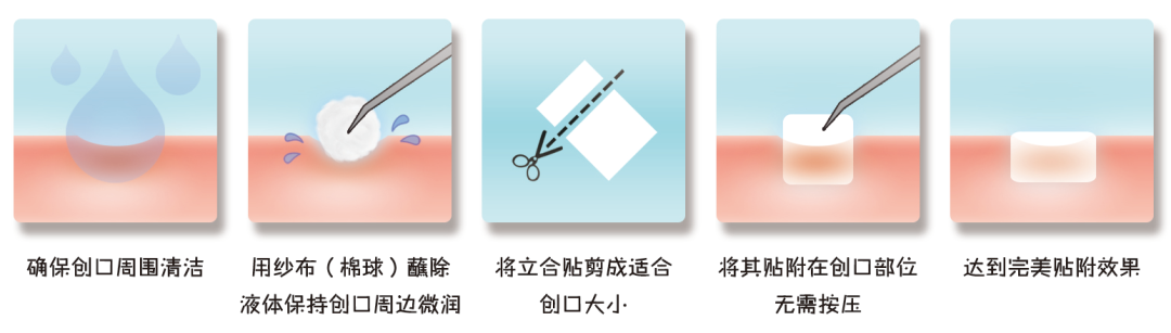 医用壳聚糖什么作用【新品上市】壳聚糖基生物医用材料--博益优立合贴（覆膜型）_https://www.jmylbn.com_新闻资讯_第6张