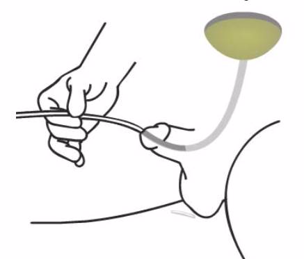 弯头导尿管怎么用行间歇导尿时，尿液导不出该怎么办？_https://www.jmylbn.com_新闻资讯_第3张
