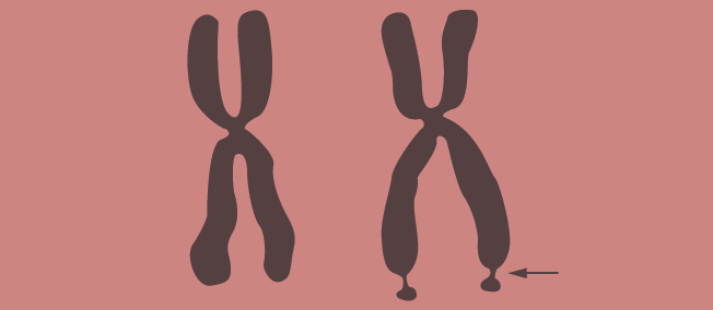 脆性X综合征 <wbr>| <wbr>一条X染色体的故事