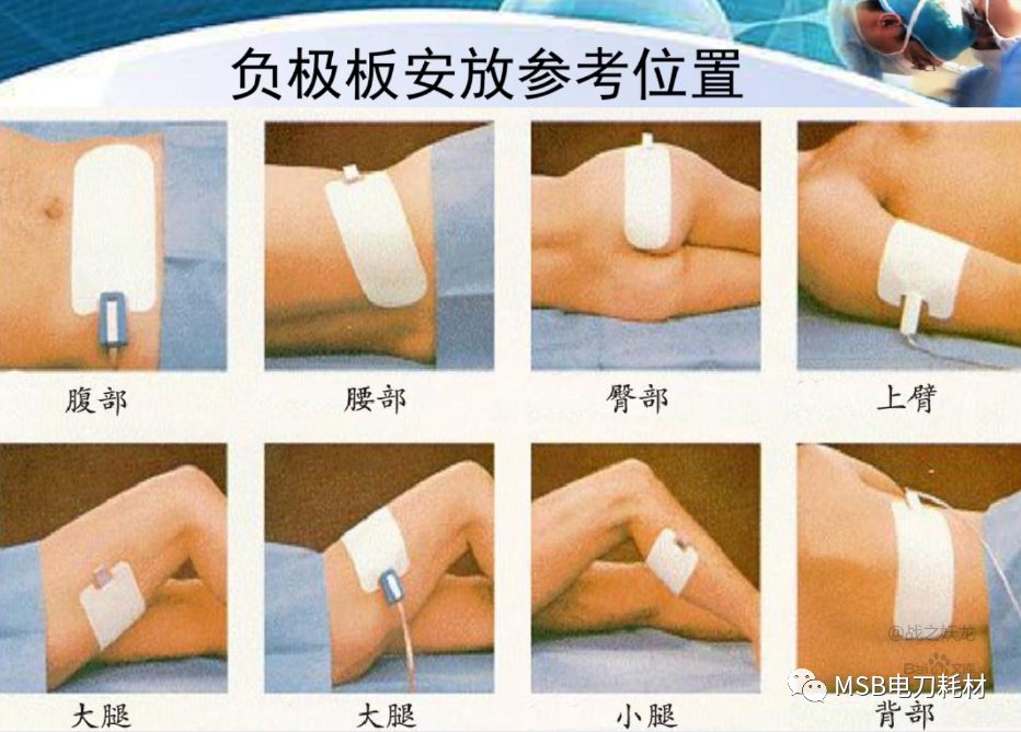 为什么手术用电刀医院手术电刀使用的安全管理措施_https://www.jmylbn.com_新闻资讯_第1张