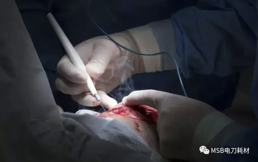 为什么手术用电刀电刀与超声刀在胸外科手术中的应用与比较_https://www.jmylbn.com_新闻资讯_第1张