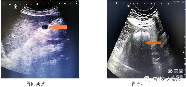 胃造影用的是什么机子超声丨如果你实在害怕胃镜，可以试试胃部彩超检查_https://www.jmylbn.com_新闻资讯_第17张