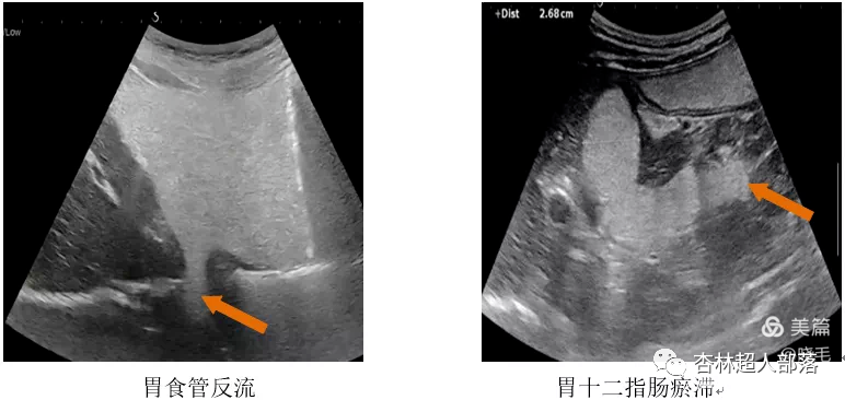 胃造影用的是什么机子超声丨如果你实在害怕胃镜，可以试试胃部彩超检查_https://www.jmylbn.com_新闻资讯_第18张