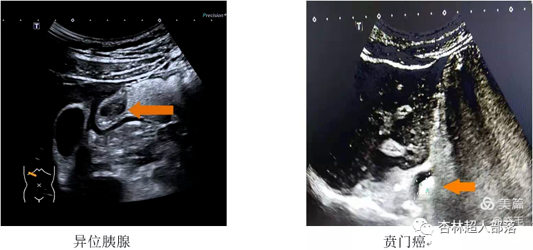 胃造影用的是什么机子超声丨如果你实在害怕胃镜，可以试试胃部彩超检查_https://www.jmylbn.com_新闻资讯_第16张