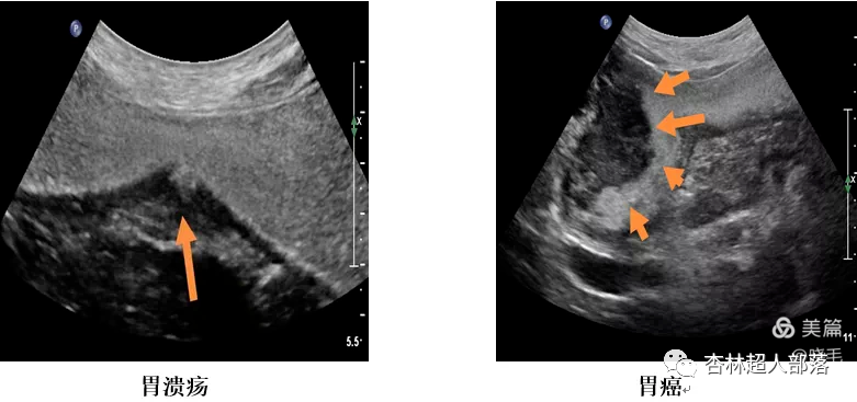 胃造影用的是什么机子超声丨如果你实在害怕胃镜，可以试试胃部彩超检查_https://www.jmylbn.com_新闻资讯_第14张