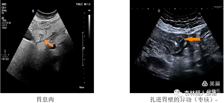 胃造影用的是什么机子超声丨如果你实在害怕胃镜，可以试试胃部彩超检查_https://www.jmylbn.com_新闻资讯_第15张