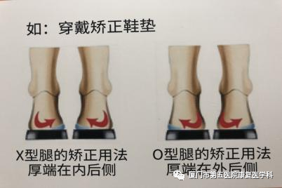 下肢关节康复器怎么用康复路上的好帮手：矫形器_https://www.jmylbn.com_新闻资讯_第20张