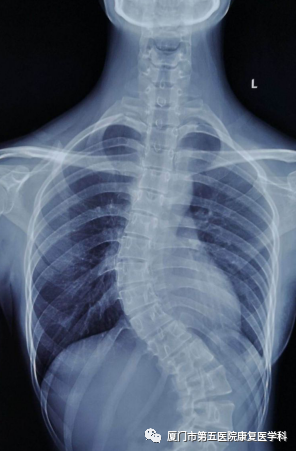 下肢关节康复器怎么用康复路上的好帮手：矫形器_https://www.jmylbn.com_新闻资讯_第21张