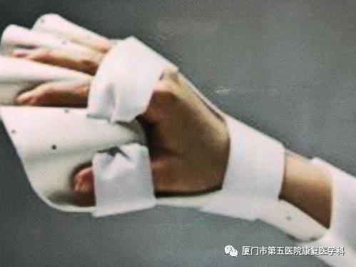 下肢关节康复器怎么用康复路上的好帮手：矫形器_https://www.jmylbn.com_新闻资讯_第18张