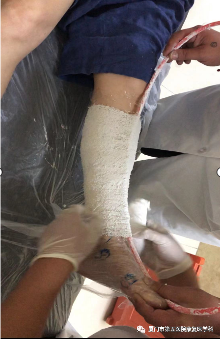 下肢关节康复器怎么用康复路上的好帮手：矫形器_https://www.jmylbn.com_新闻资讯_第31张