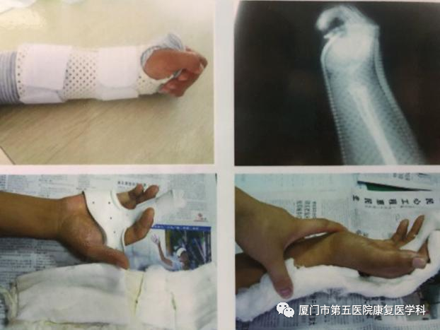 下肢关节康复器怎么用康复路上的好帮手：矫形器_https://www.jmylbn.com_新闻资讯_第12张