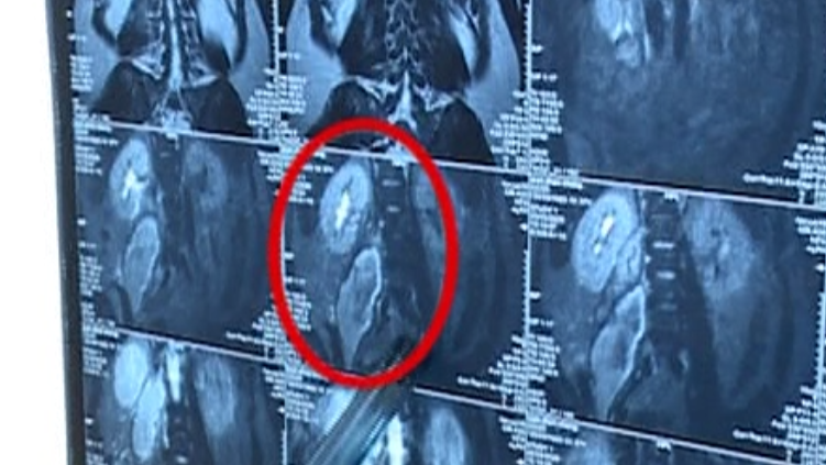 牙签【惊呆】男子高烧39℃，腰腿疼痛几个月！“元凶”竟是一根牙签......