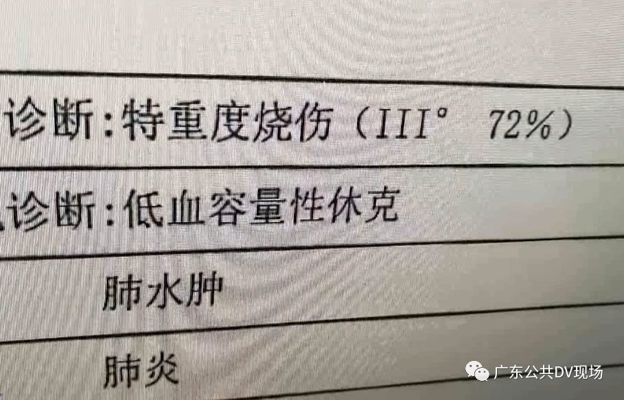 女童掉进洗澡水被大面积烫伤 医生 牢记这5个字可救命 Hi有料