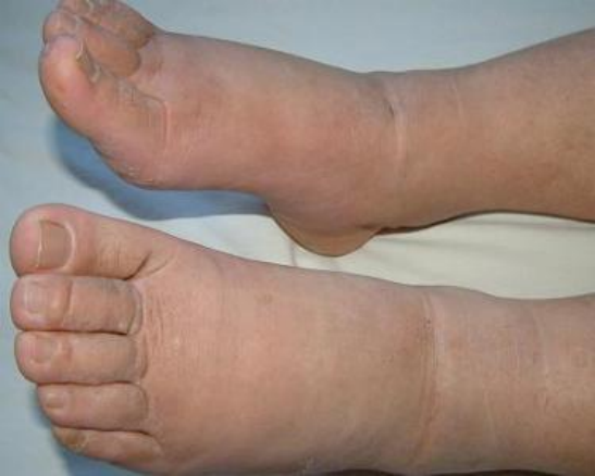 什么是压力治疗【压力治疗·上篇】原来压力治疗技术是这样的！_https://www.jmylbn.com_新闻资讯_第4张