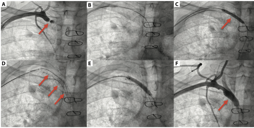 桡动脉鞘怎么读【REPLAY·周三全桡日】王鹏：双侧桡动脉入路 锁骨下支架_https://www.jmylbn.com_新闻资讯_第21张
