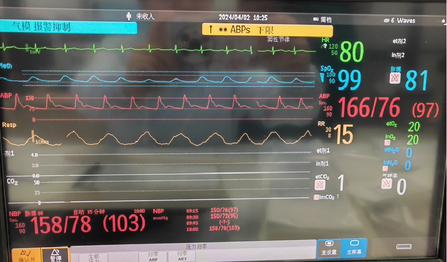 桡动脉鞘怎么读【REPLAY·周三全桡日】王鹏：双侧桡动脉入路 锁骨下支架_https://www.jmylbn.com_新闻资讯_第10张