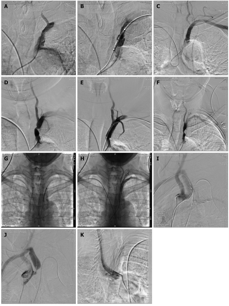 桡动脉鞘怎么读【REPLAY·周三全桡日】王鹏：双侧桡动脉入路 锁骨下支架_https://www.jmylbn.com_新闻资讯_第20张