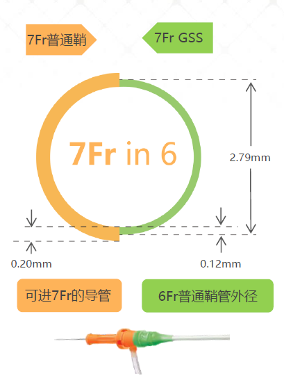 桡动脉鞘怎么读【REPLAY·周三全桡日】王鹏：双侧桡动脉入路 锁骨下支架_https://www.jmylbn.com_新闻资讯_第6张