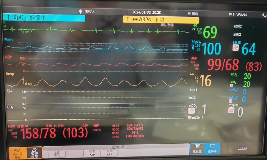 桡动脉鞘怎么读【REPLAY·周三全桡日】王鹏：双侧桡动脉入路 锁骨下支架_https://www.jmylbn.com_新闻资讯_第11张