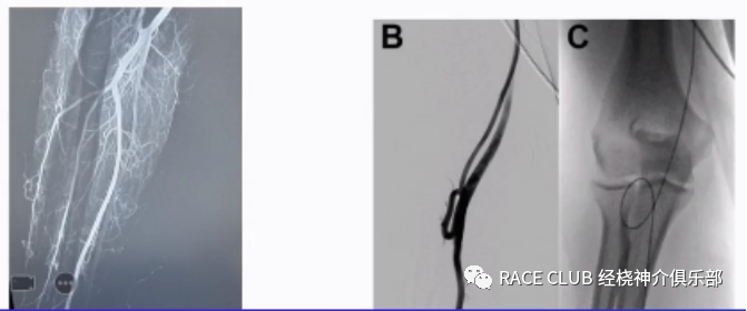 桡动脉鞘怎么读何爽教授：经桡动脉神经介入诊治的困难及并发症_https://www.jmylbn.com_新闻资讯_第3张