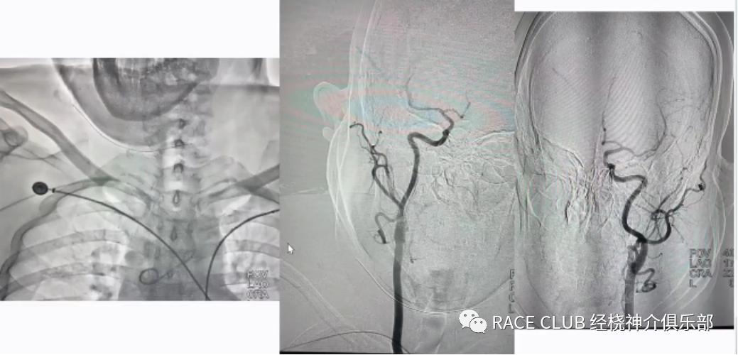 桡动脉鞘怎么读何爽教授：经桡动脉神经介入诊治的困难及并发症_https://www.jmylbn.com_新闻资讯_第11张