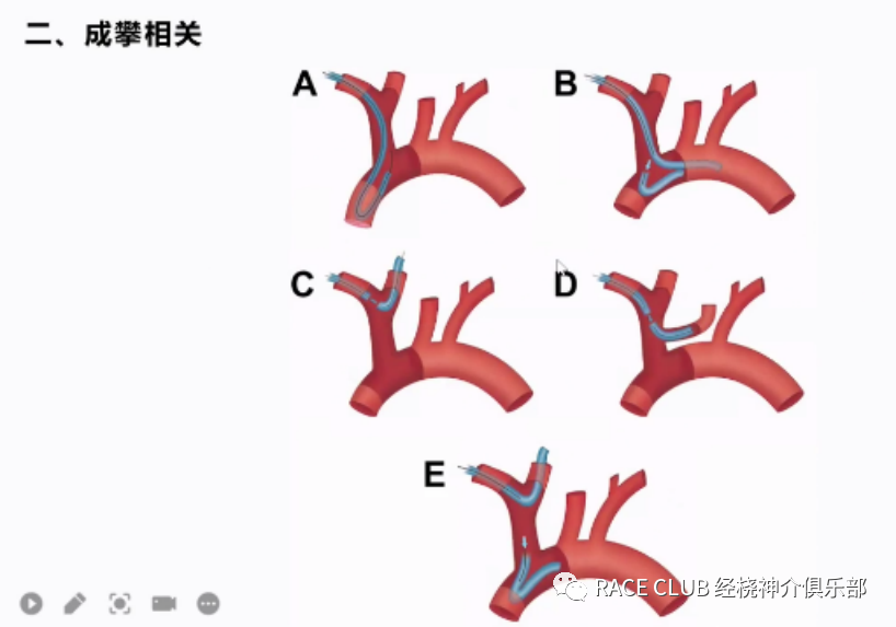 桡动脉鞘怎么读何爽教授：经桡动脉神经介入诊治的困难及并发症_https://www.jmylbn.com_新闻资讯_第7张