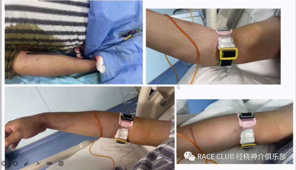 桡动脉鞘怎么读何爽教授：经桡动脉神经介入诊治的困难及并发症_https://www.jmylbn.com_新闻资讯_第6张