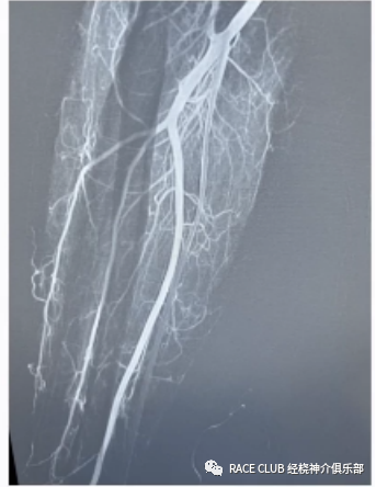 桡动脉鞘怎么读何爽教授：经桡动脉神经介入诊治的困难及并发症_https://www.jmylbn.com_新闻资讯_第8张