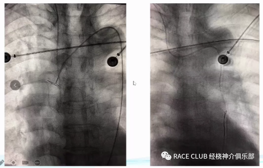 桡动脉鞘怎么读何爽教授：经桡动脉神经介入诊治的困难及并发症_https://www.jmylbn.com_新闻资讯_第14张