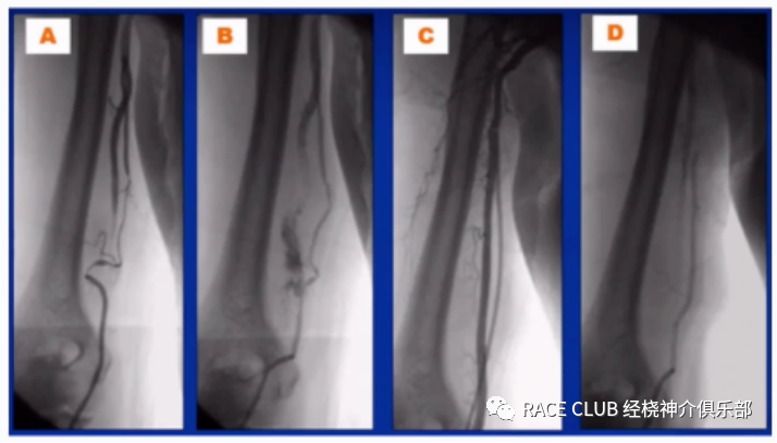 桡动脉鞘怎么读何爽教授：经桡动脉神经介入诊治的困难及并发症_https://www.jmylbn.com_新闻资讯_第4张