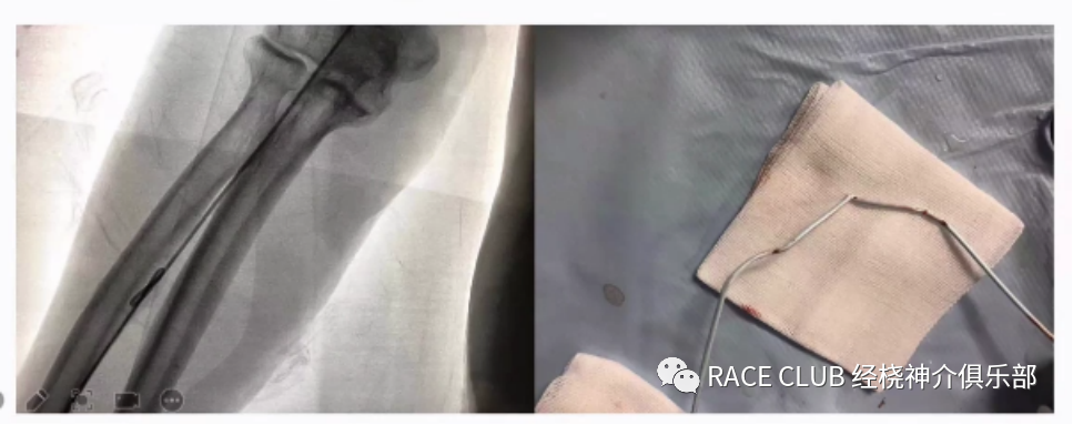 桡动脉鞘怎么读何爽教授：经桡动脉神经介入诊治的困难及并发症_https://www.jmylbn.com_新闻资讯_第12张