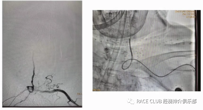 桡动脉鞘怎么读何爽教授：经桡动脉神经介入诊治的困难及并发症_https://www.jmylbn.com_新闻资讯_第13张