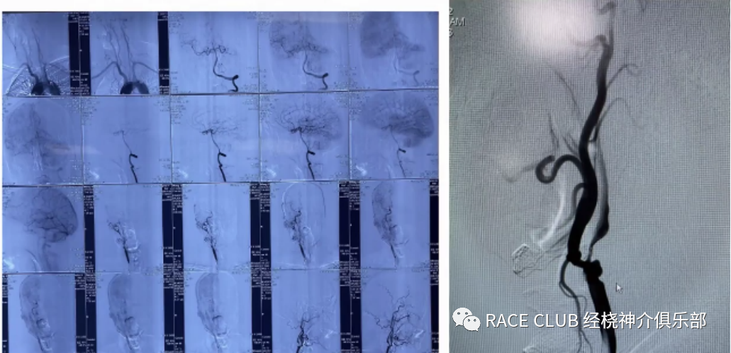 桡动脉鞘怎么读何爽教授：经桡动脉神经介入诊治的困难及并发症_https://www.jmylbn.com_新闻资讯_第17张