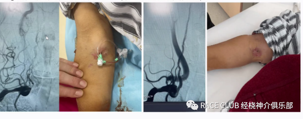 桡动脉鞘怎么读何爽教授：经桡动脉神经介入诊治的困难及并发症_https://www.jmylbn.com_新闻资讯_第5张