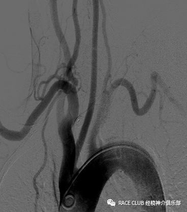 造影导丝是什么全脑血管造影术_https://www.jmylbn.com_新闻资讯_第9张