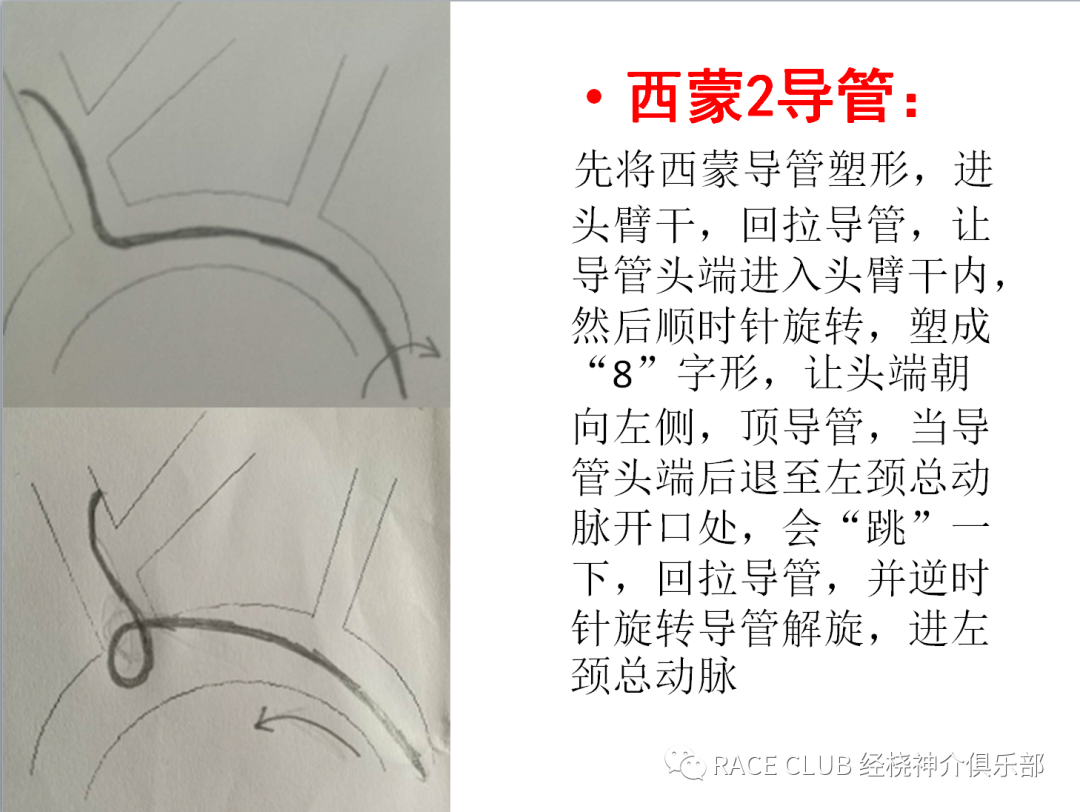 造影导丝是什么全脑血管造影术_https://www.jmylbn.com_新闻资讯_第18张