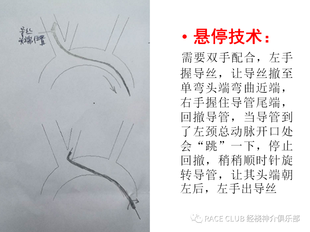 造影导丝是什么全脑血管造影术_https://www.jmylbn.com_新闻资讯_第17张