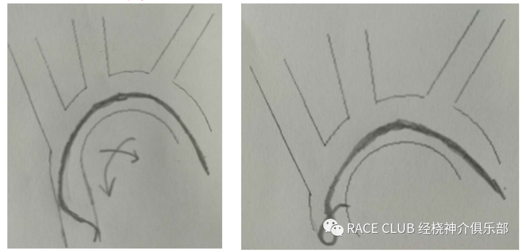 造影导丝是什么全脑血管造影术_https://www.jmylbn.com_新闻资讯_第21张