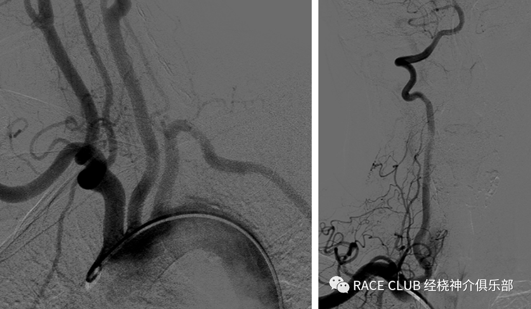 造影导丝是什么全脑血管造影术_https://www.jmylbn.com_新闻资讯_第13张