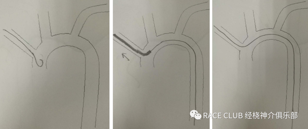 造影导丝是什么全脑血管造影术_https://www.jmylbn.com_新闻资讯_第24张