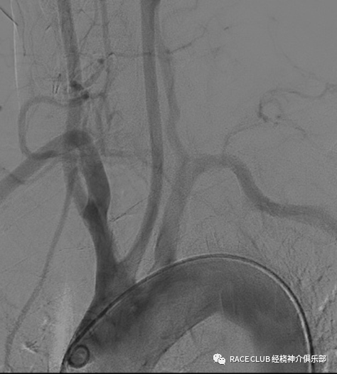 造影导丝是什么全脑血管造影术_https://www.jmylbn.com_新闻资讯_第16张