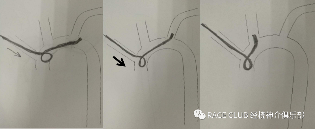 造影导丝是什么全脑血管造影术_https://www.jmylbn.com_新闻资讯_第26张