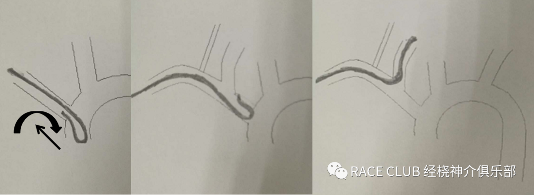 造影导丝是什么全脑血管造影术_https://www.jmylbn.com_新闻资讯_第27张