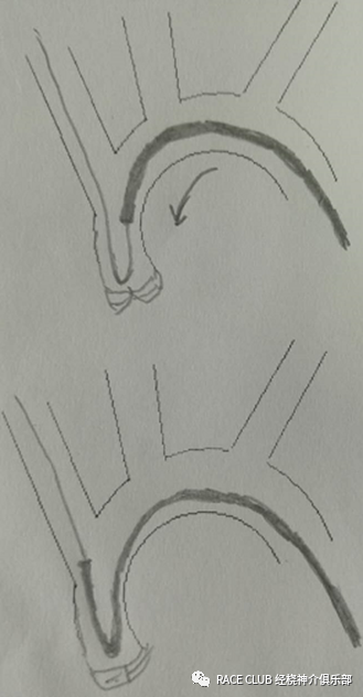 造影导丝是什么全脑血管造影术_https://www.jmylbn.com_新闻资讯_第23张