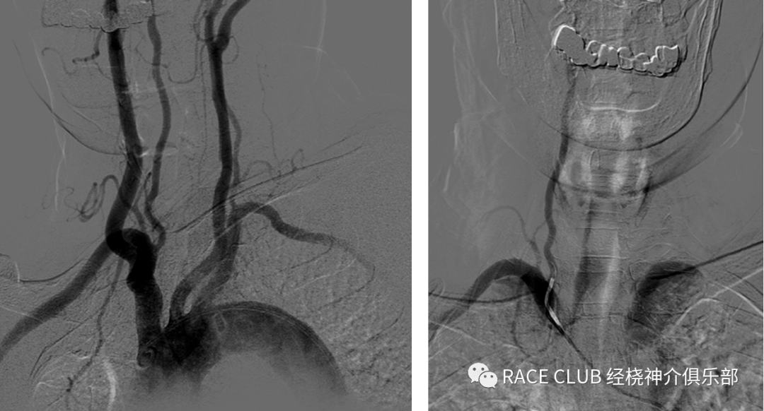 造影导丝是什么全脑血管造影术_https://www.jmylbn.com_新闻资讯_第14张