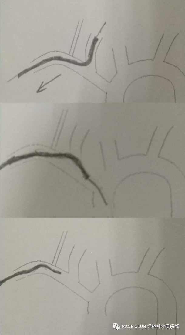 造影导丝是什么全脑血管造影术_https://www.jmylbn.com_新闻资讯_第28张