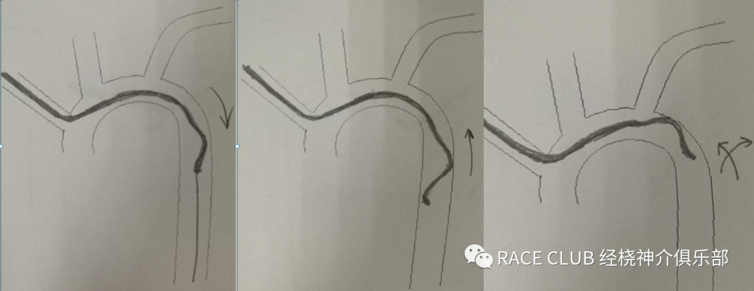 造影导丝是什么全脑血管造影术_https://www.jmylbn.com_新闻资讯_第25张