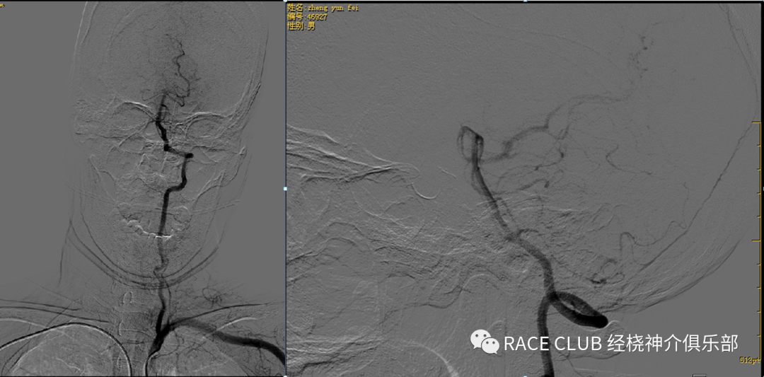 造影导丝是什么全脑血管造影术_https://www.jmylbn.com_新闻资讯_第12张