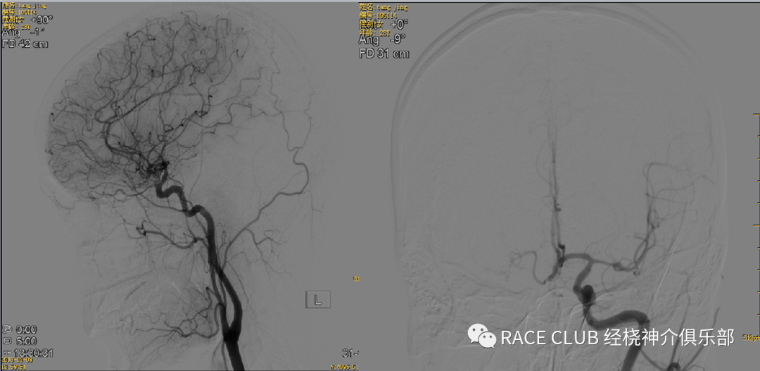 造影导丝是什么全脑血管造影术_https://www.jmylbn.com_新闻资讯_第11张